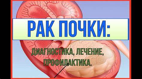 Рак почки удаление диета Рак почки: диагностика, профилактика, лечение - YouTube Рак почки: диагностика, профилактика, лечение - YouTube Рак почки удаление диета