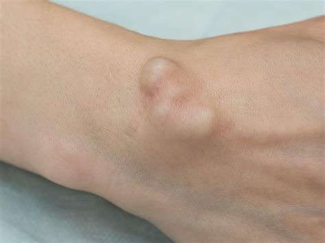 Ganglion Cyst Removal Treatment At Excellence Medical 01 2325528