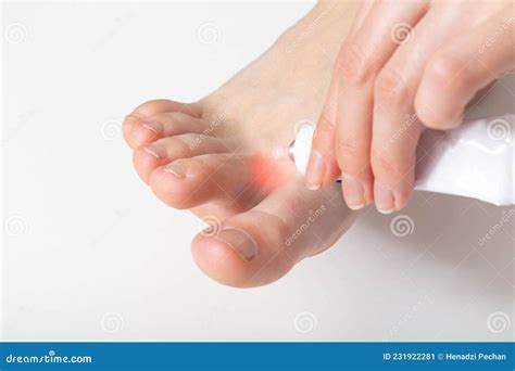 The Girl Applies A Healing Ointment Between The Toes Against Fungus And
