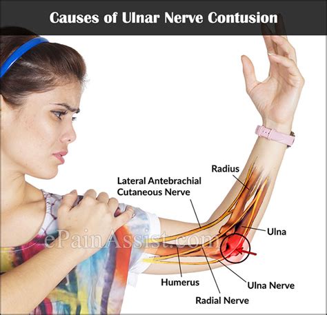 Ulnar Nerve Compression Symptoms Causes Treatment My Xxx Hot Girl