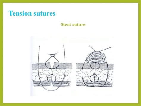 Basic Suture Patterns