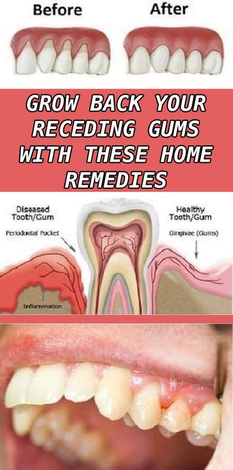 8 Easy Ways To Heal Receding Gums Naturally Gum Inflammation