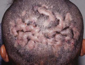 Cellulitis occurs when certain types of bacteria such as staphylococcus and streptococcus come in contact with the animal bites can also cause cellulitis. Cellulitis on Neck, Head, Scalp, Nose, Tonsil, Ear and ...
