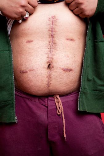 Un Macho Mostrando Su Estómago Heridas Cicatriz Cabos Sueltos Y Después De La Operación Foto De