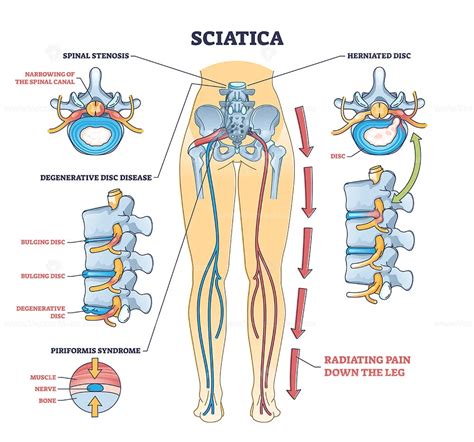 Sciatica Pain Or Nerve Weakness As Leg Lumbar Radiculopathy Outline Diagram VectorMine