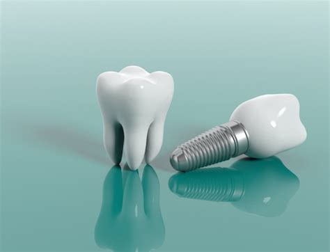 Dental Implants 101 Everything You Need To Know