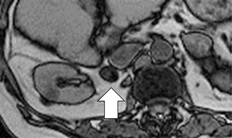 Utility Of T2 Weighted Mri To Differentiate Adrenal Metastases From