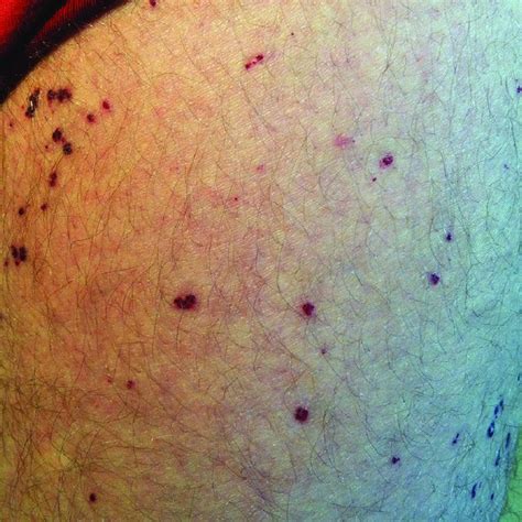 Angiokeratoma On The Patients Thigh Before He Started Enzyme