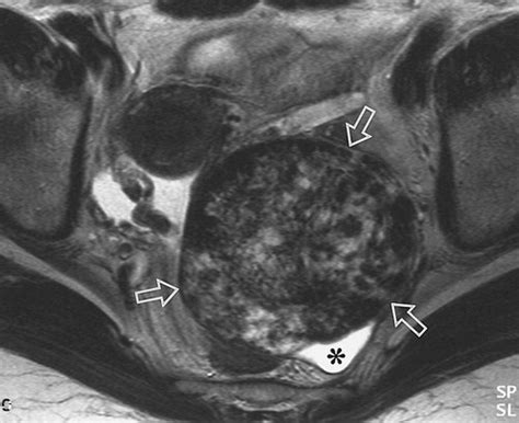 Ct And Mr Imaging Of Ovarian Tumors With Emphasis On Differential