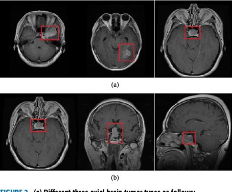 Brain Tumor Classification In Mri Image Using Convolutional Neural