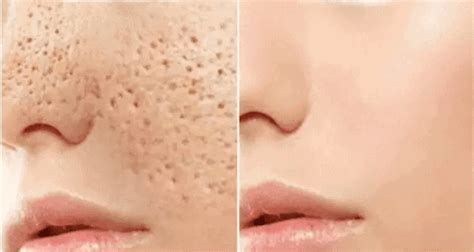 How To Get Rid Of Open Pores On Face Nose Cheeks And Skin Yeyelife
