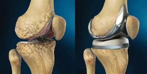 What Is Total Knee Replacement Quora Knee Replacement Total Knee