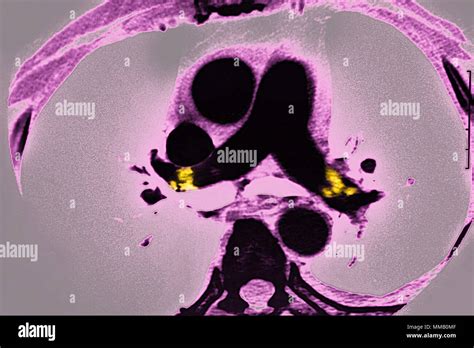 PULMONARY EMBOLISM CT SCAN Stock Photo Alamy
