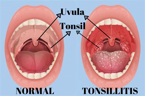 Tonsillitis All That You Should Know Living Herself
