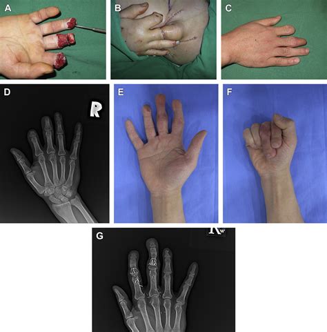 Management Of Complications Relating To Finger Amputation And