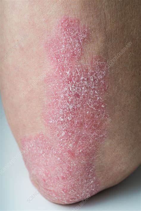 Psoriasis Stock Image C0499467 Science Photo Library