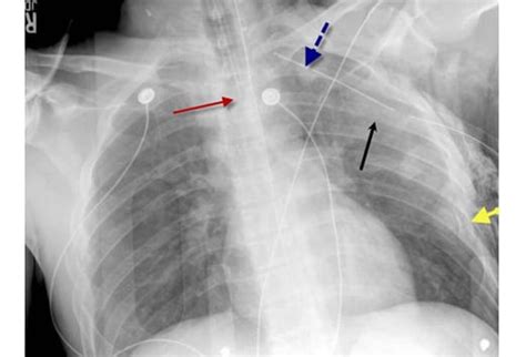 Critical Findings In Chest Trauma