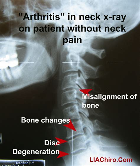 I Have Arthritis Can Chiropractic Still Help Me