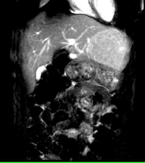 Focal Nodular Hyperplasia Fnh Body Mr Case Studies Ctisus Ct Scanning