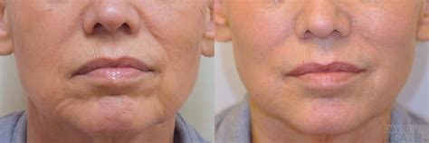 Injectable Fillers David B Reath Md