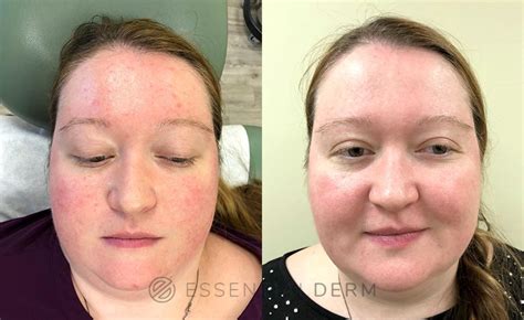 Intense Pulsed Light Ipl Before And After Photo Gallery Natick Ma