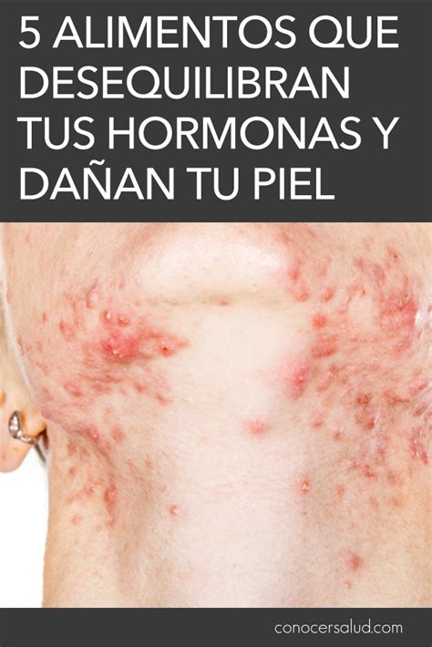 Además de aumentar los niveles de colesterol, su consumo diario propiciará un incremento considerable del estrógeno. 5 Alimentos que desequilibran tus hormonas y dañan tu piel ...