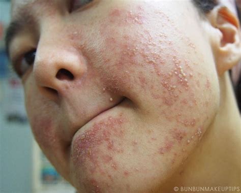 It can take several months of treatment before acne symptoms improve. No More Pretty Face | Others