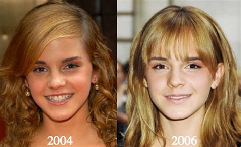 Emma Watson Boob Job And Other Plastic Surgery Before And After