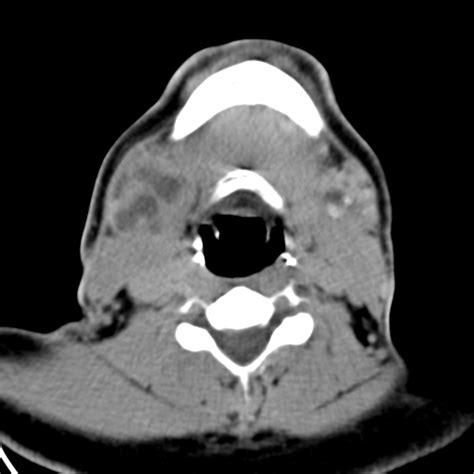 Bilateral Submandibular Sialolithiasis With Sialadenitis Image