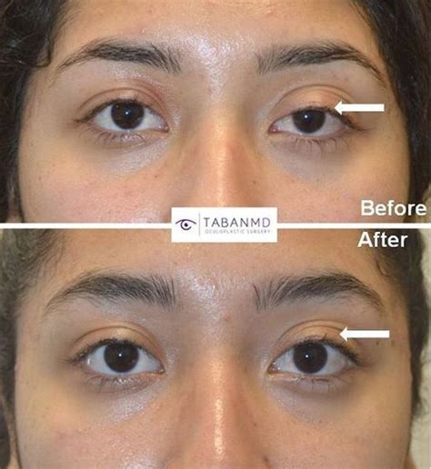 Patient Before And After In 2020 Eyelid Surgery Upper Eyelid Surgery
