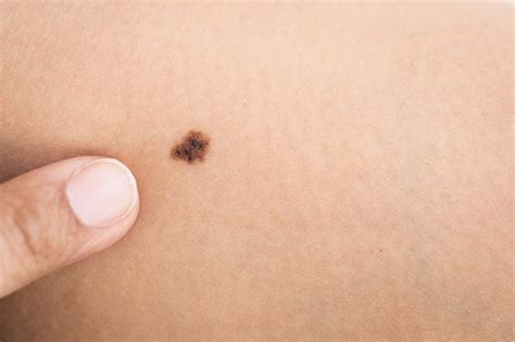 What Are Birthmarks Types And Treatments Upmc Healthbeat