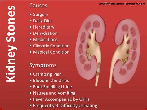 Kidney Stones Causes And Symptoms Good Info Proactive Nursing
