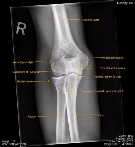 Elbow X Ray Anatomy