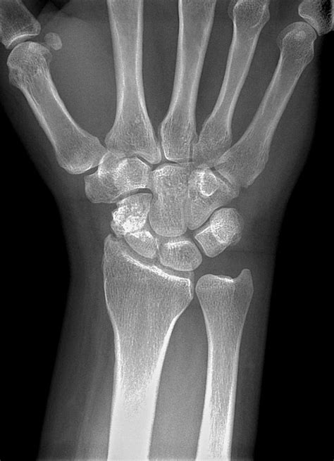 Fractured Wrist X Ray Photograph By Du Cane Medical Imaging Ltd