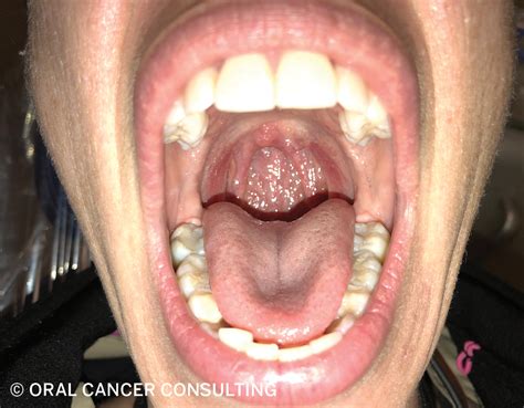 How To Perform A Head And Neck Oral Oropharyngeal Cancer Screening