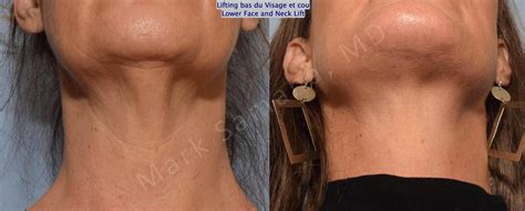 lifting du visage cou facelift necklift avant and après photos before and after pictures
