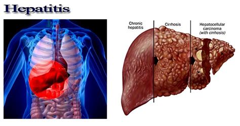 Spiritual And Physical Health Tips All About Hepatitis Disease