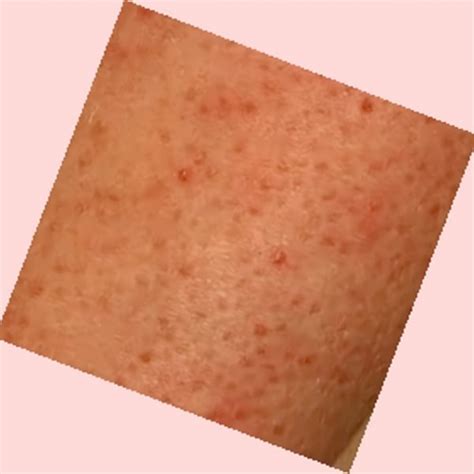Bumps On Skin Dorothee Padraig South West Skin Health Care