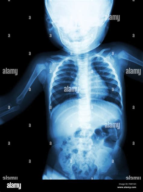 Film X Ray Child S Body Normal Baby Stock Photo Alamy