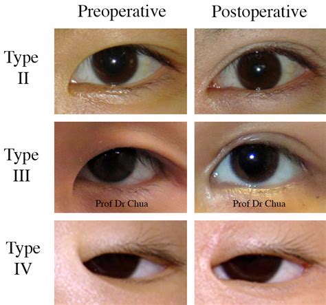 Epicanthus is a vertical fold of skin over the angle of the inner canthus of the eye. Eyelid Surgery by Prof Dr CN CHUA 蔡鐘能: Doc, Do I Need ...