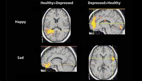 Brain Scans Could Predict Major Depression Risk Massdevice