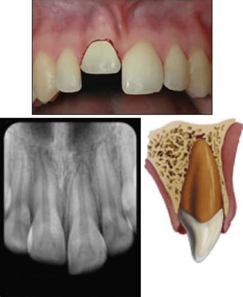 Dental Intrusion News Dentagama