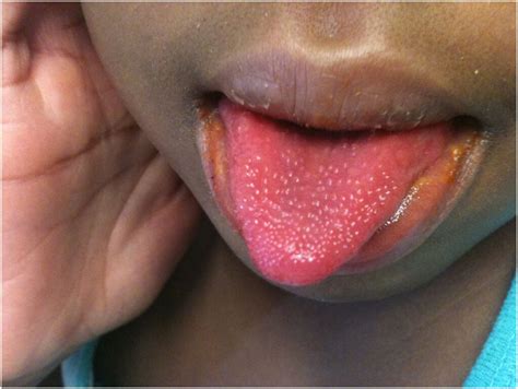 Red Spots On Tongue Under Back Tip Of Tongue Healcure