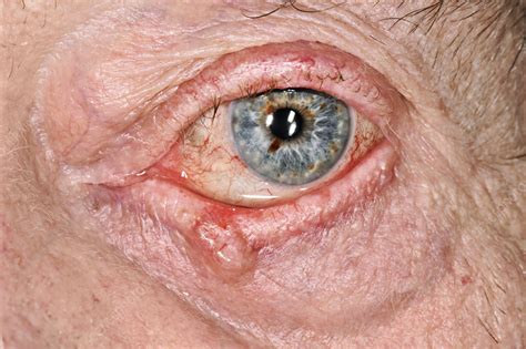 Basal Cell Carcinoma On The Eyelid Stock Image C0401409 Science