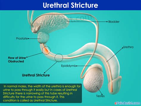 Urethral Stricture Treatment Exercise Prognosis Causes Symptoms