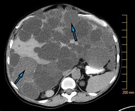 Cureus A Case Report Of A Ventral Hernia Containing A Liver Cyst In A