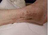 Treatment For Scar Tissue After Back Surgery Pictures