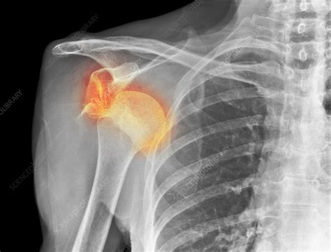 Dislocated Shoulder X Ray Stock Image F0083444 Science Photo