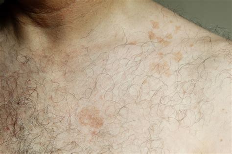 Tinea Versicolor Treatment How To Get Rid Of Tinea Versicolor