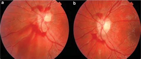 A Left Fundus Optic Nerve Swelling With Peri Papillary Haemorrhages